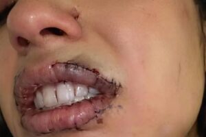 💔 Lo que parecía un retoque terminó en años de dolor: la historia que alerta a miles