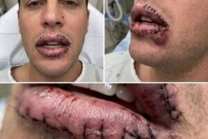 Fotografías de un hombre con los labios suturados se vuelven virales: esto es lo que realmente puede observarse