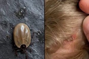 ¿Encontraste este insecto en la cabeza de tu hijo? Lo que debes saber sobre las garrapatas y cómo actuar correctamente